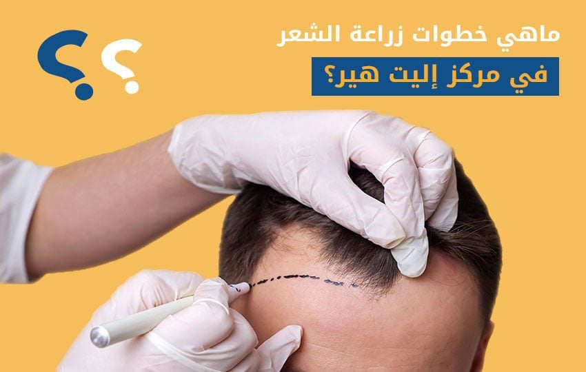 تعرف على خطوات زراعة الشعر باحترافية كاملة في مركز إليت هير تخطيط لكل خطوة بدقة متناهية