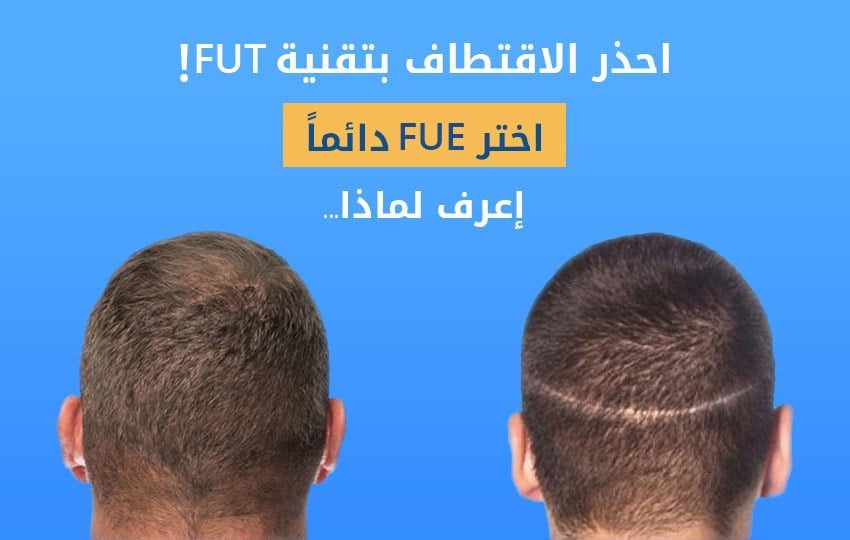 إقرأ لماذا عليك اختيار تقنية FUE لاقتطاف البصيلات في كل مرة إليت هير