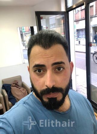 السيد مجد بعد عملية زراعة الشعر في إليت هير بـ 7 أشهر