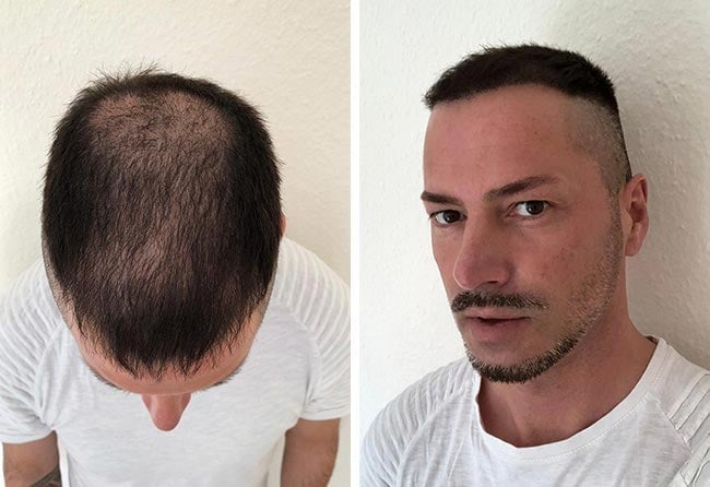 بعد 3 شهور من عملية زراعة الشعر فى تركيا للسيد أندريه