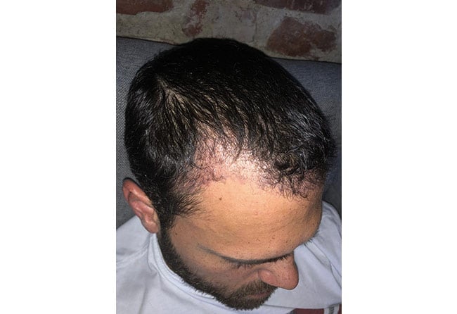 بعد زراعة الشعر فى تركيا للسيد ستيفان بتقنية السفير