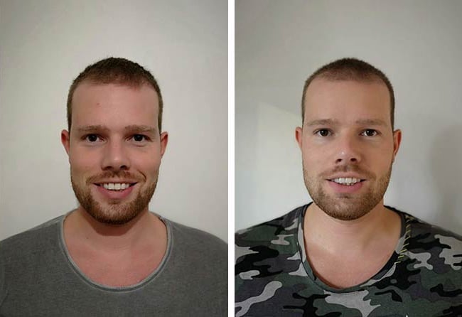 زراعة الشعر قبل وبعد 3 شهور فى تركيا للسيد ألكساندر