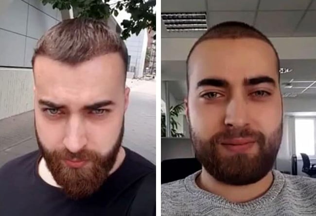 زراعة الشعر قبل وبعد 4 شهور فى تركيا فى مركز اليت هير