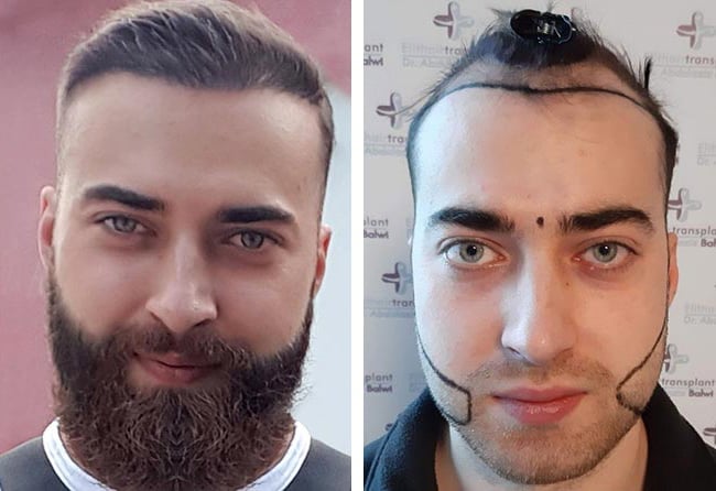 زراعة الشعر قبل وبعد فى تركيا فى مركز اليت هير