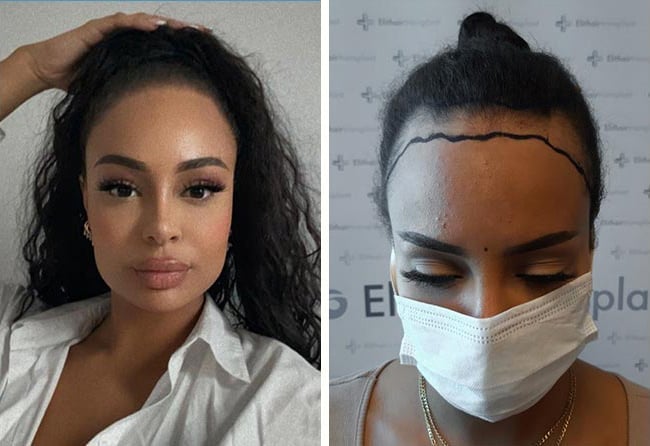 زراعة الشعر قبل وبعد فى تركيا للأنسة جاهي فى مركز اليت هير