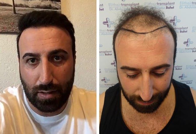 زراعة الشعر قبل وبعد فى تركيا للسيد آرتين | مركز اليت هير