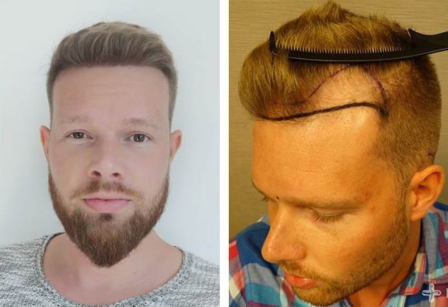 زراعة الشعر قبل وبعد فى تركيا للسيد ألكساندر
