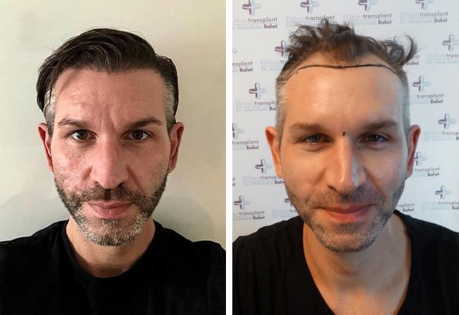 زراعة الشعر قبل وبعد فى تركيا للسيد توماس