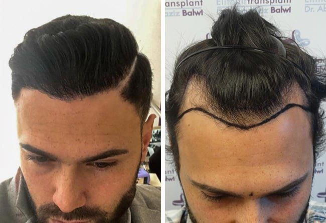 زراعة الشعر قبل وبعد فى تركيا للسيد ستيفان