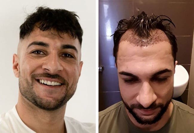 زراعة الشعر قبل وبعد فى تركيا للسيد عثماني