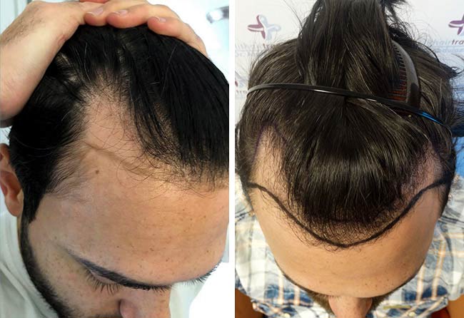 قبل زراعة الشعر فى تركيا للسيد ستيفان