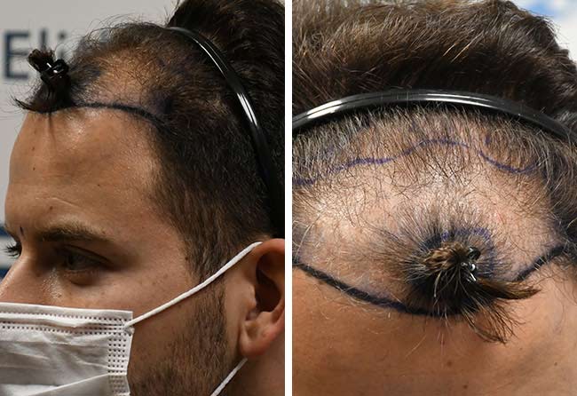 قبل عملية زراعة الشعر فى تركيا مركز اليت هير