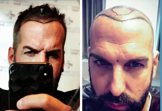 قبل عملية زراعة الشعر للسيد يورغن فى تركيا مركز اليت هير