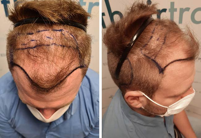 قبل عملية زراعة الشعر فى تركيا مركز اليت هير