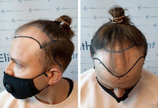 قبل عملية زراعة الشعر فى تركيا | مركز اليت هير