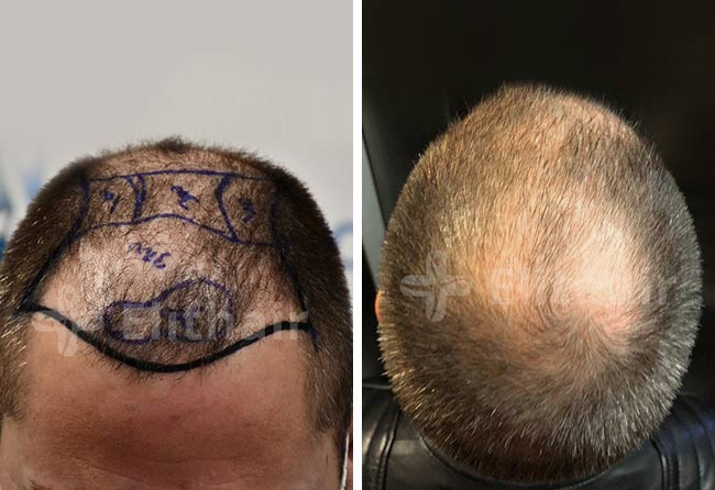قبل عملية زراعة الشعر فى تركيا للسيد أندريه فى مركز اليت هير