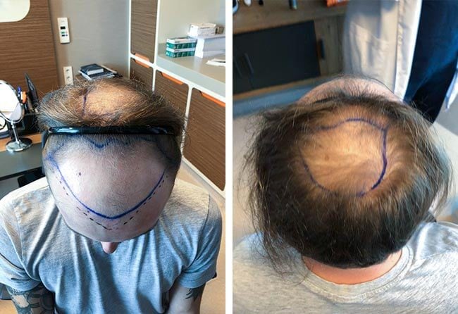 قبل عملية زراعة الشعر فى تركيا للسيد فريدريك | مركز اليت هير