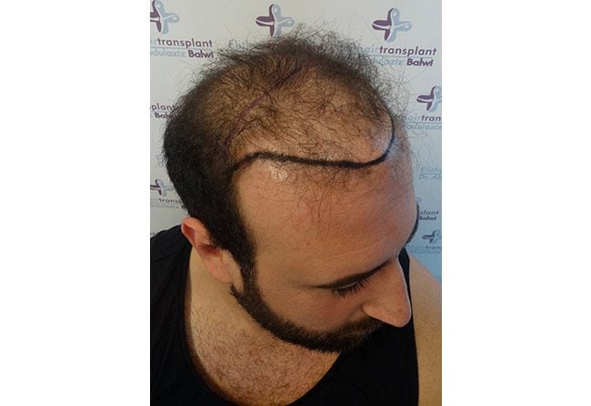 قبل عملية زراعة الشعر فى تركيا مركز اليت هير