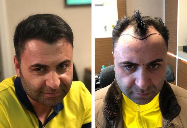 قبل وبعد عملية زراعة الشعر في تركيا مركز اليت هير
