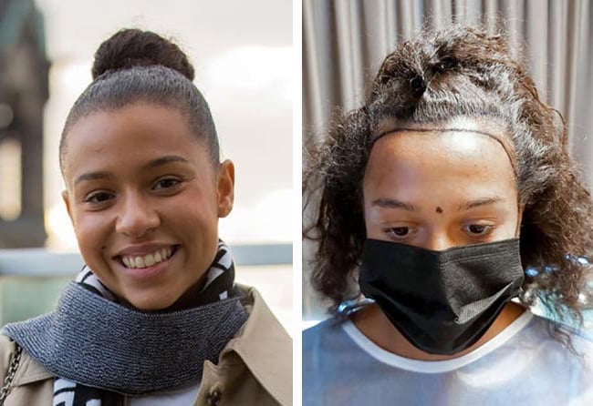 قبل وبعد عملية زراعة الشعر في تركيا مركز اليت هير