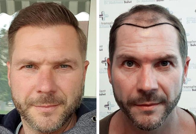قبل وبعد عملية زراعة الشعر في تركيا مركز اليت هير