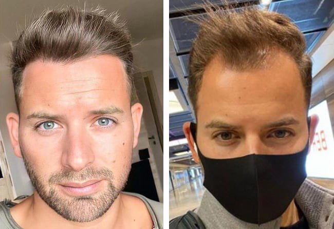 قبل وبعد عملية زراعة الشعر فى تركيا مركز اليت هير