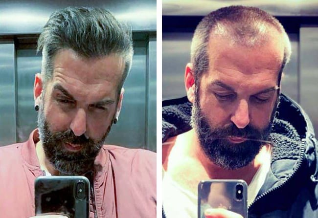 قبل وبعد عملية زراعة الشعر للسيد يورغن في تركيا مركز اليت هير