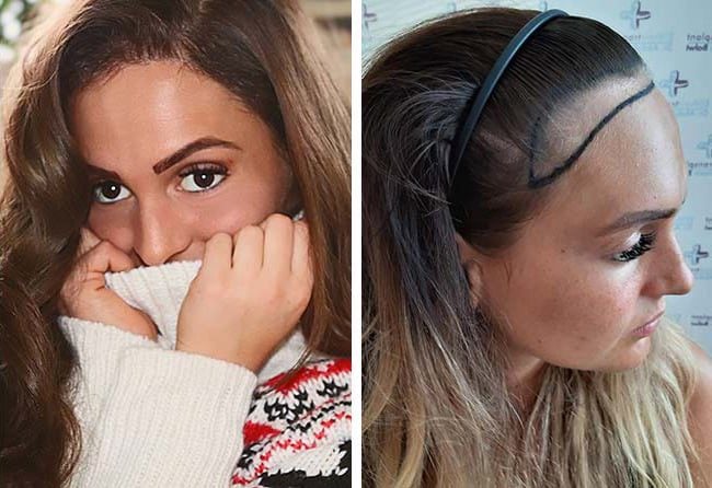 قبل وبعد عملية زراعة الشعر للآنسة كارين في تركيا مركز اليت هير