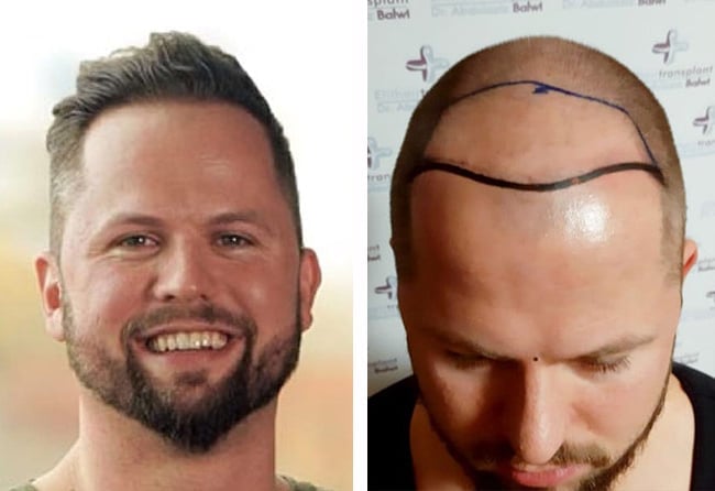 قبل وبعد عملية زراعة الشعر في تركيا مركز اليت هير