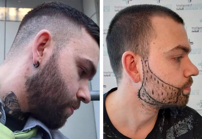 قبل وبعد عملية زراعة شعر الذقن