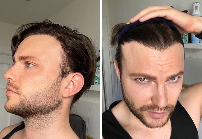 نتائج زراعة الشعر فى تركيا بتقنية السفير | مركز اليت هير