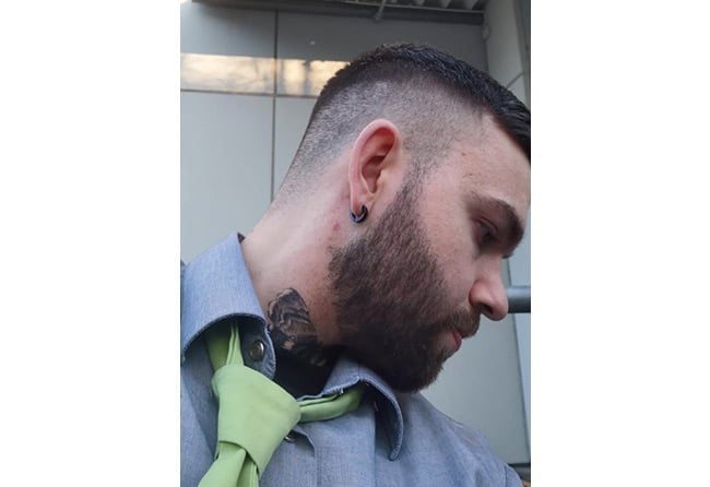 نتائج زراعة عملية شعر اللحية