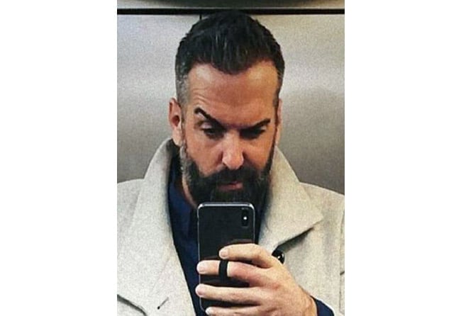 نتائج عملية زراعة الشعر للسيد يورغن في تركيا في مركز اليت هير