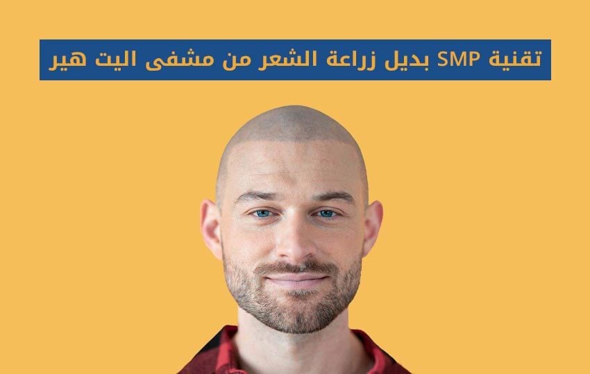 تقنية SMP بديل زراعة الشعر من مركز اليت هير