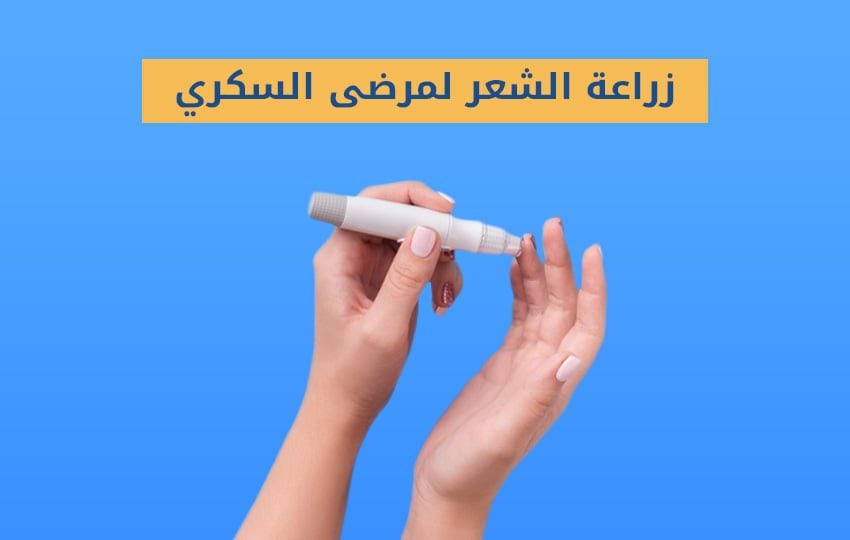 زراعة الشعر لمرضى السكري في مركز اليت هير