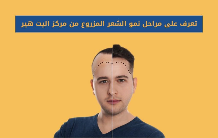 مراحل نمو الشعر بعد الزراعة في مركز اليت هير