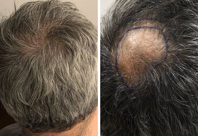زراعة الشعر قبل وبعد فى تركيا للسيد زياد مركز اليت هير
