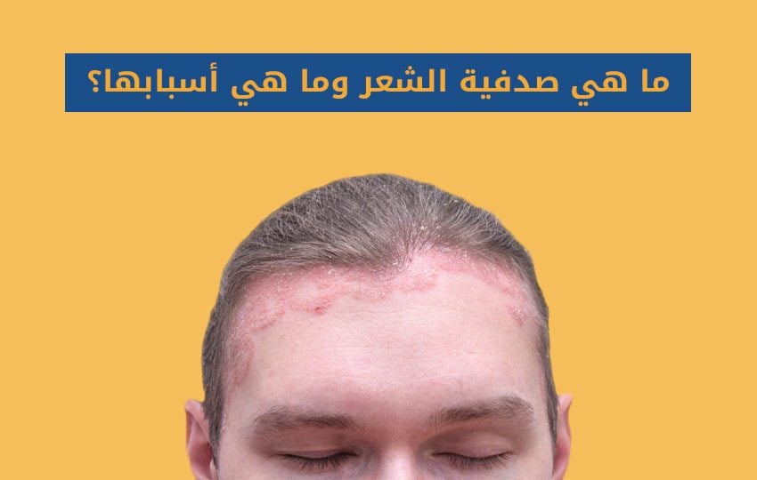 كل شيء عن صدفية الشعر من مركز اليت هير