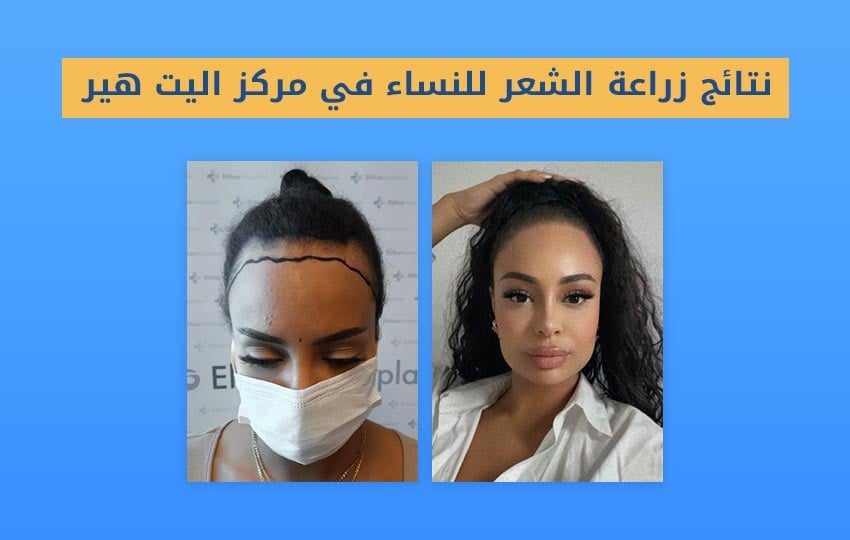 زراعة شعر الجبهة للنساء | مركز اليت هير
