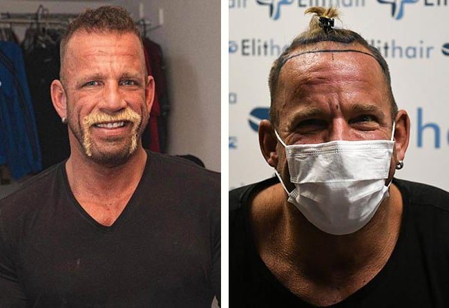 قبل وبعد عملية زراعة الشعر في تركيا مركز اليت هير
