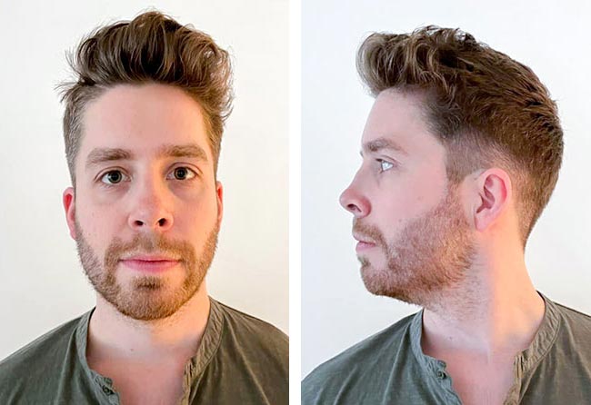 4 زراعة شعر بعد شهور للسيد إيكي مركز اليت هير