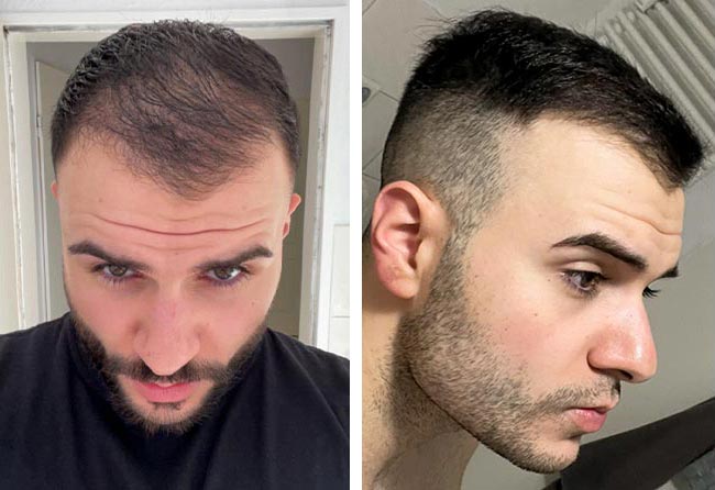 بعد 3 شهور عملية زراعة الشعر للسيد أوكان مركز اليت هير