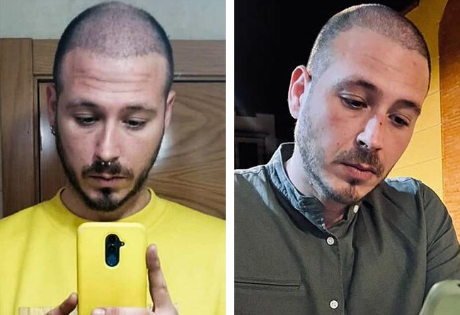 بعد 3 شهور عملية زراعة الشعر للسيد خورخي مركز اليت هير