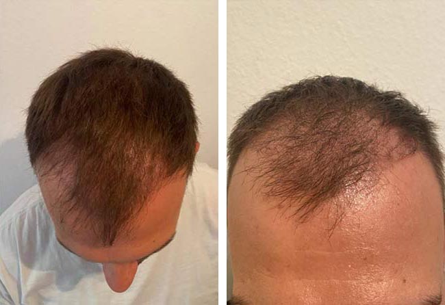 بعد 3 شهور عملية زراعة الشعر للسيد سيفكيت | اليت هير