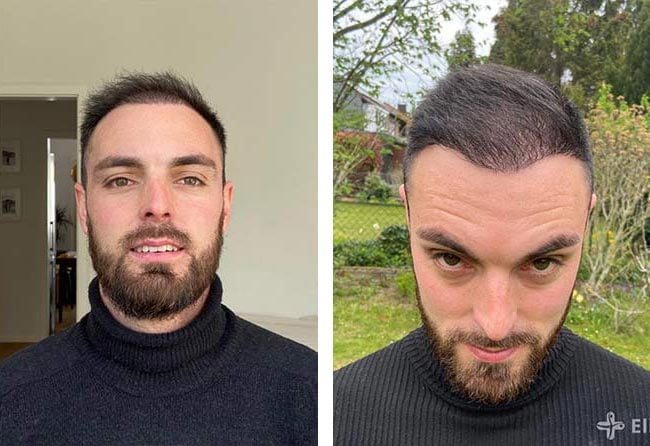 بعد 4 شهور عملية زراعة الشعر للسيد سيباستيان مركز اليت هير