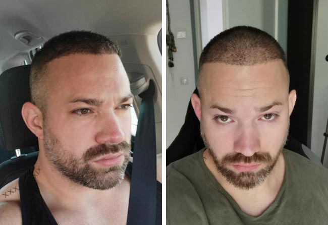 بعد 4 شهور عملية زراعة الشعر للسيد مانويل | اليت هير