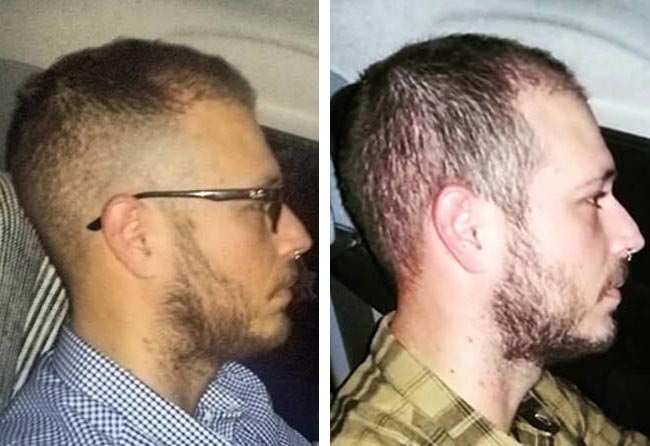 بعد 5 شهور عملية زراعة الشعر للسيد خورخي مركز اليت هير