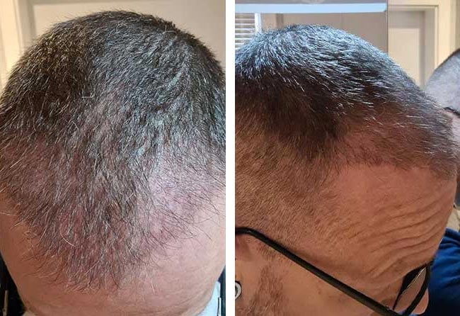 بعد 5 شهور عملية زراعة الشعر للسيد ستيفن مركز اليت هير