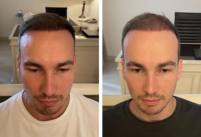 بعد 6 شهور زراعة الشعر للسيد مارسيل | مركز اليت هير