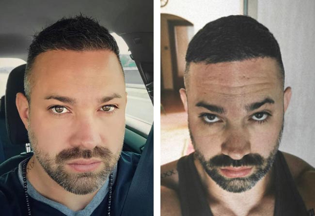 بعد 6 شهور عملية زراعة الشعر للسيد مانويل | اليت هير
